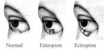 Eyelids-Normal-Entropion-Ectropion.jpg